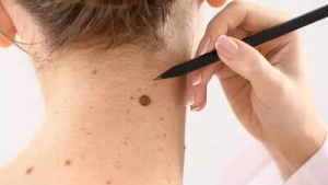 Don't Ignore These Early Warning Signs of Melanoma: Hidden Skin Cancer Risks Revealed